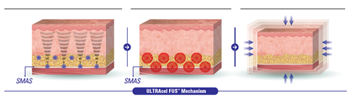 ULTRAcel Q+_illust_2